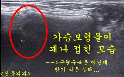 구형구축이 아닌데 방이 작아서 가슴보형물교체하면서 피막을 열어서 넓혔던 분
