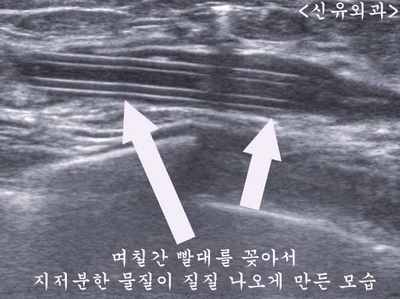 11cm크기의 가슴지방이식부작용석회화지방괴사된 멍울을 제거하고 빨대(배액관) 꽂았던 분