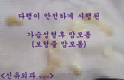 가슴보형물에서 0.8mm떨어진 멍울을 맘모톰으로 안전하게 제거하면서, 재발된 함몰유두 교정수술해 드렸던 분