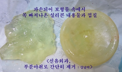 타병원에서 가슴보형물파손진단되어 오신 분 제거수술 : 뒷면 접합부위 구형구축없이
