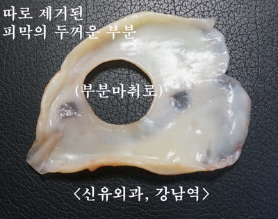 가슴보형물과 일부 극히 두꺼워진 피막을 같이 제거한 교체수술
