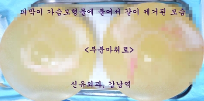 확대수술후 몇 년 후 갑자기 가슴이 커져서 부분마취로 보형물교체하고 이중피막제거