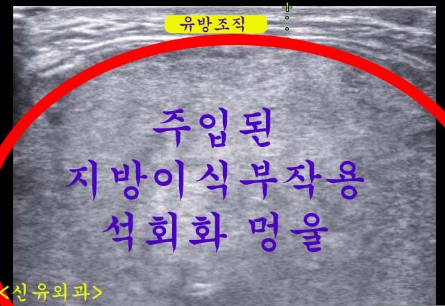 가슴의 15cm 크기 커다란 멍울은 지방이식부작용석회화괴사조직이었고...
