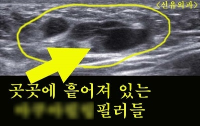 가슴필러부작용치료로 급성염증 생기기 전에 제거한 경우