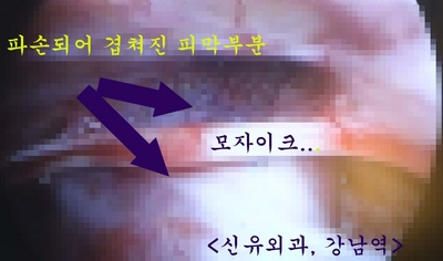 물방울보형물주변의 과다장액이 피막을 찢어서 멍울로 만져졌던 분