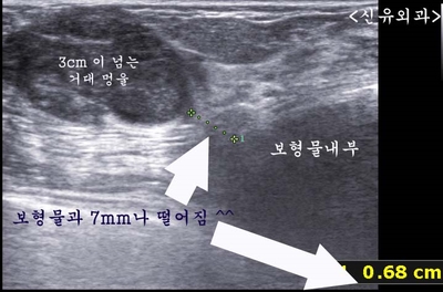 거대종양도 가슴보형물파손없이 안전하게 제거된 맘모톰수술