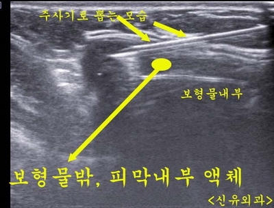 가슴보형물파손제거교체수술하고, 겨드랑이쪽 방을 막고, 2cm거상술까지 부분마취로 동시에