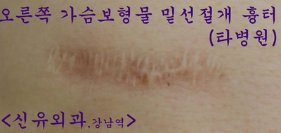 회전된 물방울가슴보형물을 부분마취하여 스무스로 교체하고 흉터교정술해 드린 분