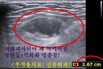 가슴지방이식부작용석회화멍울치료가 오히려 문제되어서 오신 분
