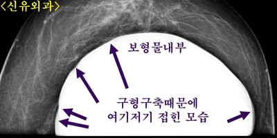 구형구축가슴보형물제거하면서 임신출산수유후 처진가슴올리는 거상술 동시 시행