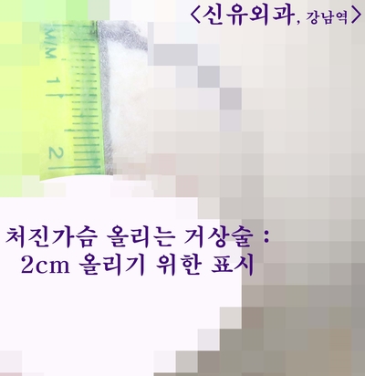 스무스와 텍스처가 섞여 있었던 분 가슴보형물교체하면서 거상술&맘모톰도 동시에.