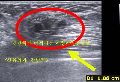 줄기세포자가지방 가슴이식 3차까지 했는데 3년만에 멍울과 통증으로 부작용석회화 치료받으심