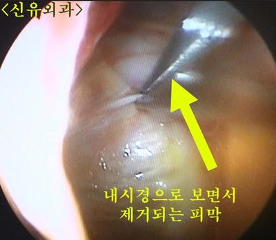 하이드로겔가슴보형물파손을 부분마취로 제거하고 늘어진 피막도 내시경으로 제거