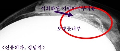 가슴지방이식부작용 석회화멍울에서 정말 염증이 나왔고, 제거된 보형물 주변에서도(대학병원에선 그냥 두자고 했는데) 염증이 나왔던 분