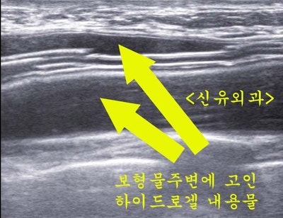 파손된 가슴보형물 제거: 하이드로겔과 생리식염수백이 같이 들어있던 분