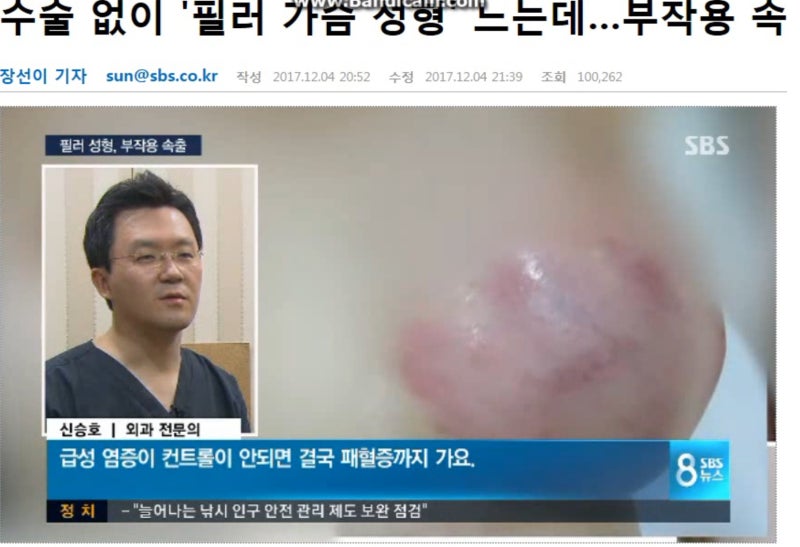 SBS 8시 뉴스, 가슴필러부작용 (신승호원장 인터뷰)