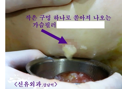 가슴필러부작용 제거치료 내시경사진