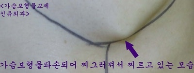 Poland syndrome(폴랜드증후군) 가슴보형물파손교체 : 부분마취로