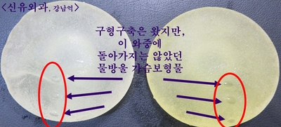 구형구축은 왔지만 물방울이 회전하지는 않았던 가슴보형물제거교체