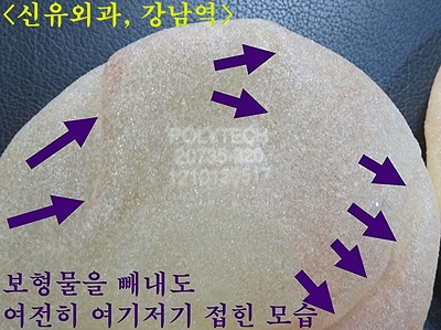 구형구축온 가슴보형물제거하며 처진가슴올리는 거상술 전후사진