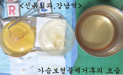 겨드랑이포트까지 제거하고 보형물교체한 가슴성형재수술<--밑선찝기도