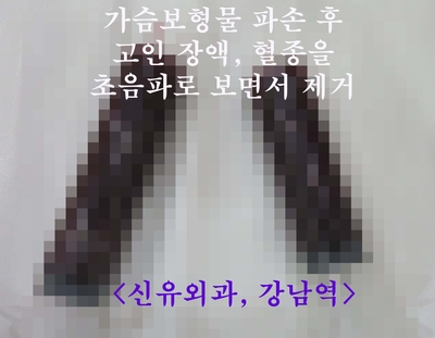 캐나다에서 오신 파손된 옛날실리콘가슴보형물제거수술후기