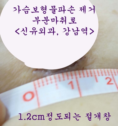 생리식염수백파손(변색됨)으로 가슴보형물제거(부분마취)하신 분