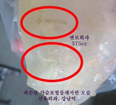 MRI에서 보형물파손 없다고 했지만 초음파상 파손 의심 소견: 보형물제거해 확인한 경우