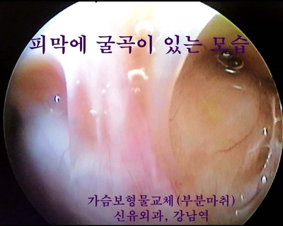 배꼽 생리식염수백을 부분마취로 가슴보형물교체하며 처진가슴거상술, 맘모톰까지 동시에