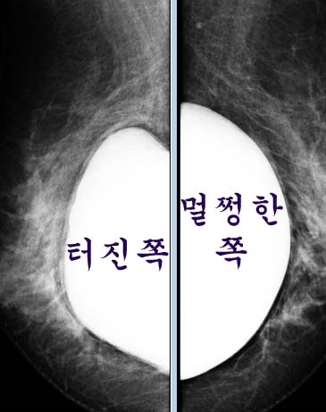 "영미영미!!!" ; 속으로 외친, 파손된 가슴보형물제거 (피막이 조약돌같았던 교체수술)