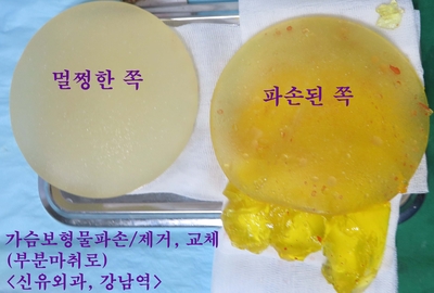 가슴보형물파손되어 실리콘이 피막을 찢고 주변까지 번진 분: 보형물제거/교체수술