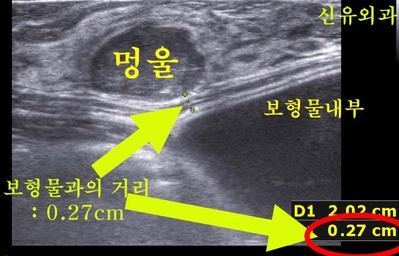 가슴보형물과 0.27cm떨어진 멍울을 파손없이 맘모톰수술