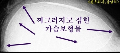 피막이 찢어지고 근육손상까지 생겼던 분: 가슴보형물제거, 교체하는 성형재수술 (부분마취로)