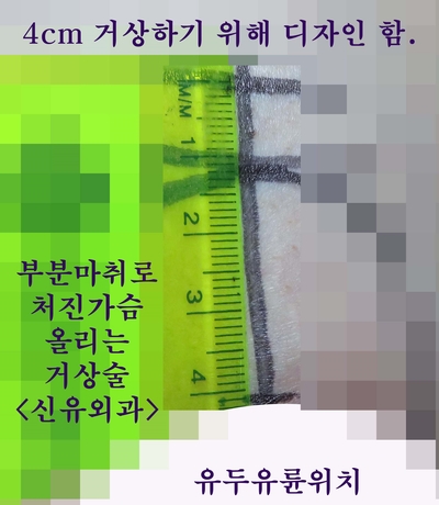 가슴보형물제거하며 처진가슴올리는 거상술, 맘모톰수술까지 동시에