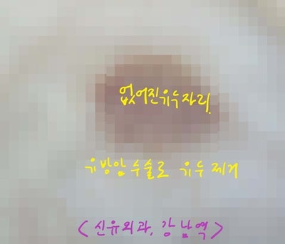 유두재건술을 어떤 방식으로 하나, 신유외과는.