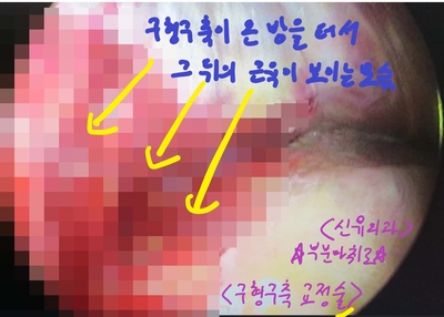 구형구축때문에 밀린 보형물을 가슴성형재수술(부분마취로)하여 교정