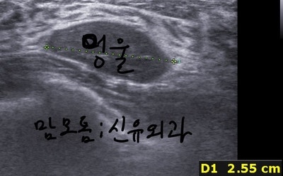 겨드랑이접근으로 흉터조차 보이지 않게 한 고난도맘모톰수술