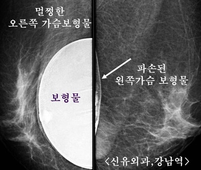 곰팡이가 핀 것으로 착각했던 가슴보형물파손제거교체수술과, 처진가슴 올리는 거상술을 동시에.
