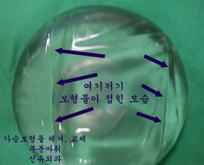 뒤늦게 염증 발견되어 가슴보형물제거수술하신 분