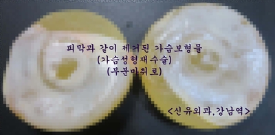 구형구축 피막제거도 하고 보형물교체, 맘모톰도 했던 가슴성형재수술