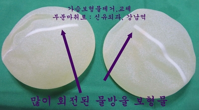 비유착되어 회전된 물방울가슴보형물을 제거교체하며 부분마취로 성형재수술