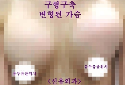 실리콘보형물파손, 구형구축으로 가슴이 변형되었던 분