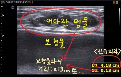 4cm가 넘는 거대유방종양도, 보형물이 파손되지 않게 맘모톰으로 제거합니다.
