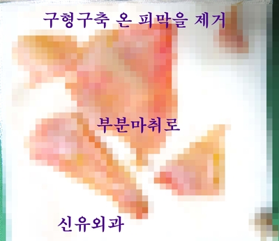 과다장액 비유착 가슴보형물제거교체하고 구형구축 생긴 피막도 제거