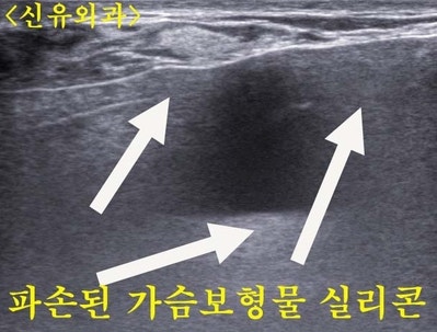 파손된 가슴보형물 제거 교체하고 피막 두꺼운 것 제거하고 처진가슴 끌어올리는 거상술까지, 부분마취로 한 번에