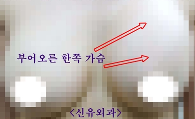 피막을 넘어 근육까지 찢어져서 오셨던 가슴성형부작용 --> 부분마취로 제거, 교체까지도