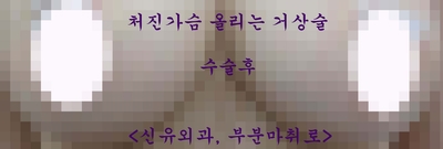 과다박리된 방을 찝고, 뒤집어진 가슴보형물을 제거교체하며 처진가슴 올리는 거상술도