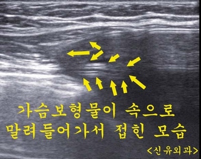 구형구축이 아닌데 방이 작아져서 가슴보형물이 접히고 피막을 찌르던 통증. 부분마취로 보형물제거교체