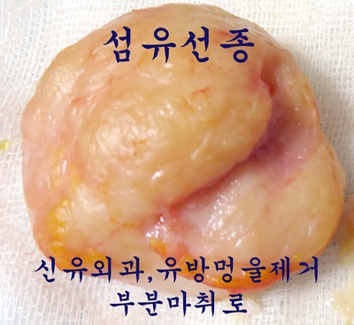 유방멍울 섬유선종 제거술(부분마취로)