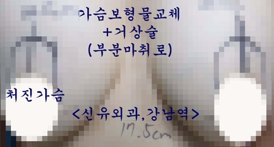 처진가슴 끌어올리는 유방거상술을 하면서 파손된 보형물을 제거 교체하는 성형재수술